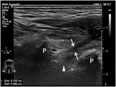 Diagnostic performance of preoperative ultrasound for traumatic brachial plexus root injury: A comparison study with an electrophysiology study